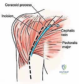 صورة رنين مغناطيسي توضح امتداد الورم