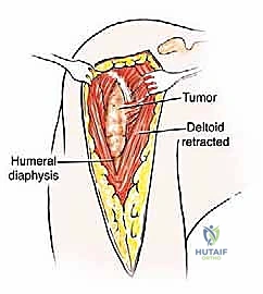 تقييم الأشعة المقطعية قبل الجراحة