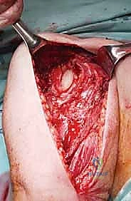 أشعة سينية تظهر تدمير العظم