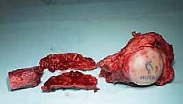 صورة طبية: علاج نقائل العضد السرطانية جراحياً في صنعاء استئصال وإعادة بناء متقدمة