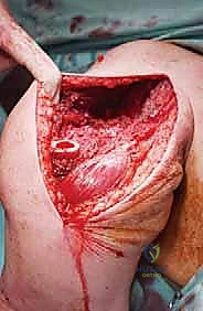 تجهيز المريض في غرفة العمليات