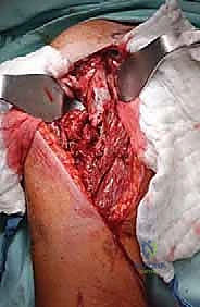 تصنيف مواقع الأورام في العضد