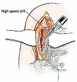 تركيب مفصل صناعي خاص بالأورام