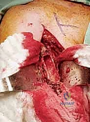 مرحلة إعادة البناء المعدني