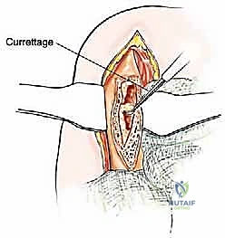 صورة إشعاعية للمسمار النخاعي