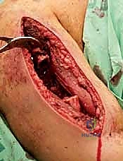 صورة توضيحية لـ علاج نقائل العضد السرطانية جراحياً في صنعاء استئصال وإعادة بناء متقدمة