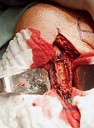 استخدام الإسمنت العظمي والشرائح