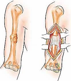 عزل الأعصاب الدقيقة