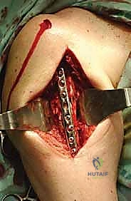 صورة توضيحية لـ علاج نقائل العضد السرطانية جراحياً في صنعاء استئصال وإعادة بناء متقدمة