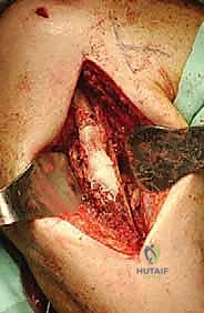 صورة توضيحية لـ علاج نقائل العضد السرطانية جراحياً في صنعاء استئصال وإعادة بناء متقدمة