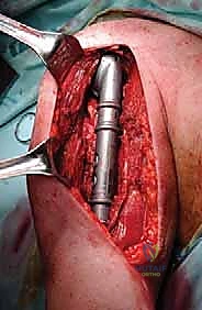 صورة توضيحية لـ علاج نقائل العضد السرطانية جراحياً في صنعاء استئصال وإعادة بناء متقدمة