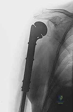 صورة توضيحية لـ علاج نقائل العضد السرطانية جراحياً في صنعاء استئصال وإعادة بناء متقدمة