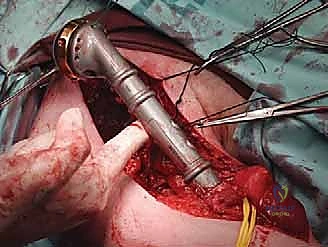 صورة طبية: علاج نقائل العضد السرطانية جراحياً في صنعاء استئصال وإعادة بناء متقدمة