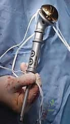 صورة طبية: علاج نقائل العضد السرطانية جراحياً في صنعاء استئصال وإعادة بناء متقدمة