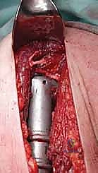 صورة طبية: علاج نقائل العضد السرطانية جراحياً في صنعاء استئصال وإعادة بناء متقدمة