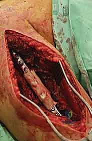 صورة طبية: علاج نقائل العضد السرطانية جراحياً في صنعاء استئصال وإعادة بناء متقدمة