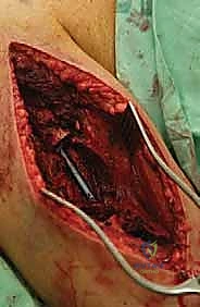 صورة طبية: علاج نقائل العضد السرطانية جراحياً في صنعاء استئصال وإعادة بناء متقدمة