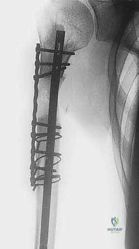 Intraoperative Surgical Step