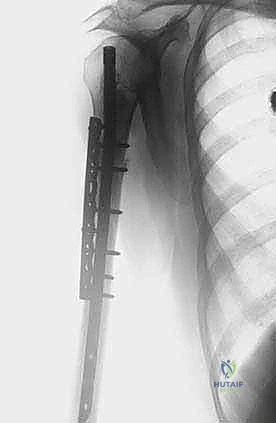 صورة طبية: علاج نقائل العضد السرطانية جراحياً في صنعاء استئصال وإعادة بناء متقدمة