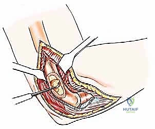 صورة طبية: علاج نقائل العضد السرطانية جراحياً في صنعاء استئصال وإعادة بناء متقدمة