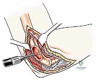 صورة طبية: علاج نقائل العضد السرطانية جراحياً في صنعاء استئصال وإعادة بناء متقدمة