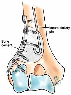 صورة طبية: علاج نقائل العضد السرطانية جراحياً في صنعاء استئصال وإعادة بناء متقدمة
