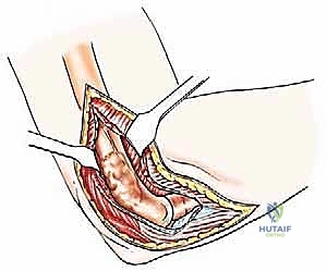 صورة طبية: علاج نقائل العضد السرطانية جراحياً في صنعاء استئصال وإعادة بناء متقدمة