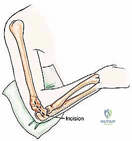 صورة طبية: علاج نقائل العضد السرطانية جراحياً في صنعاء استئصال وإعادة بناء متقدمة