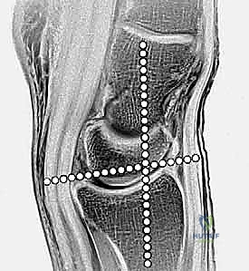 آلية السقوط على اليد