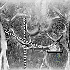 إغلاق الجرح