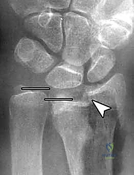 إبعاد الأوتار