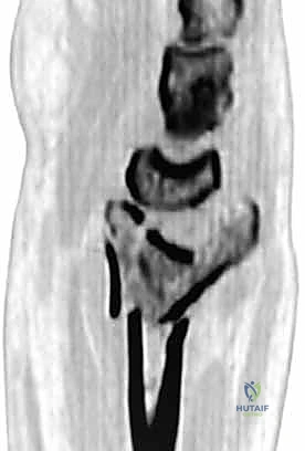 التصوير المقطعي للكسر