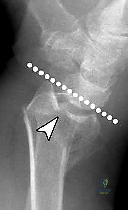 الشق الجراحي للرسغ
