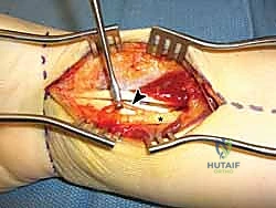 توضيح الصفيحة الأمامية