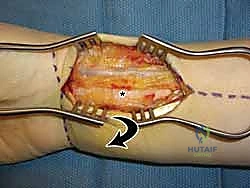 تثبيت المسامير