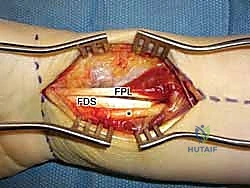 صورة أشعة بعد الشفاء التام