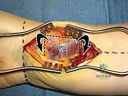 نجاح جراحة رياضي