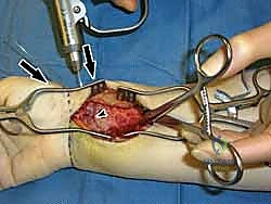 التثبيت بأسلاك K-wires