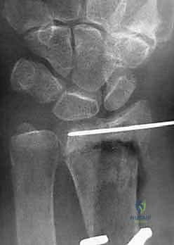 مناقشة الفوائد مع المريض