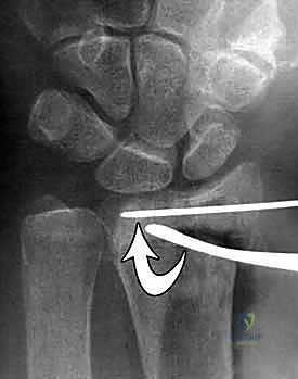 تمارين دوران الساعد