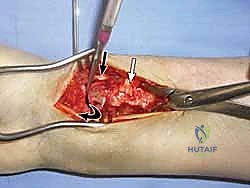 نجاح جراحة سيدة مسنة