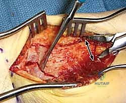 تمارين ثني الرسغ