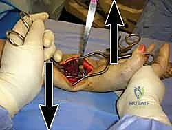 صفيحة التيتانيوم في الجسم