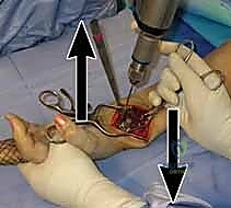 إدخال المسامير
