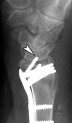 تقوية قبضة اليد
