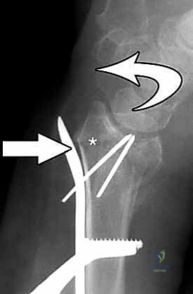 استخدام الأشعة المباشرة