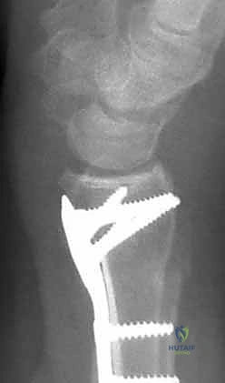 وضع الصفيحة