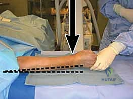 تثبيت المسامير القشرية