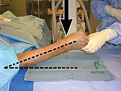 صورة توضيحية لـ إتقان تثبيت كسور الكعبرة البعيدة بالصفيحة الأمامية: دليل شامل للمرضى مع الأستاذ الدكتور محمد هطيف