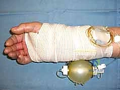 تثبيت الكسر مع هشاشة العظام